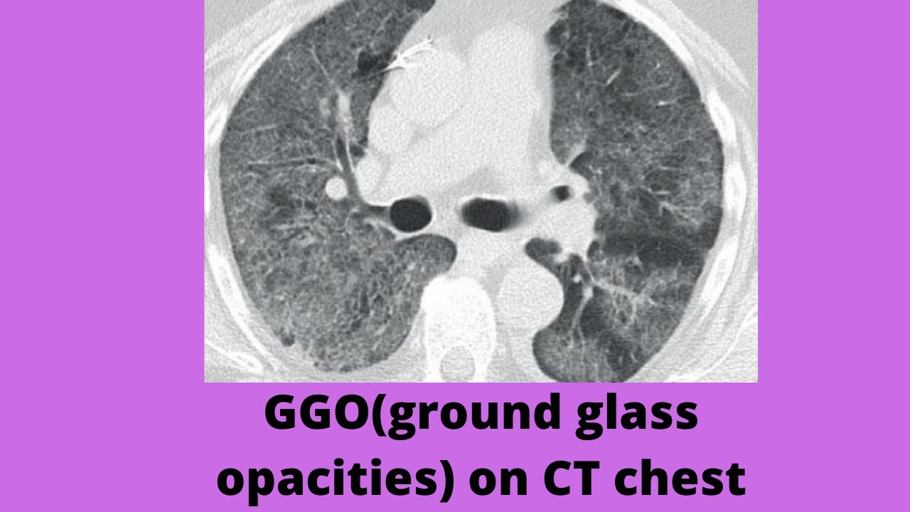 ground glass haze on CT chest