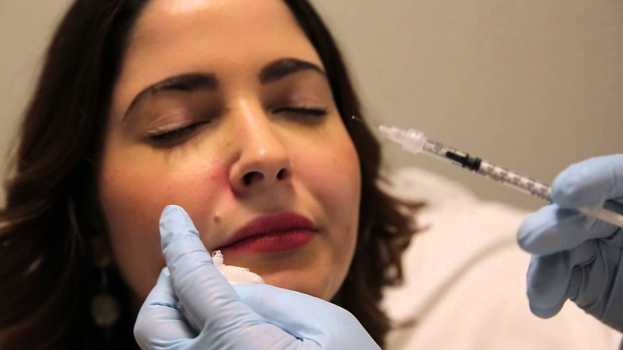 Botulinum Toxin Injection for Gummy Smile