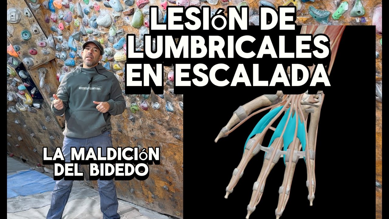 Lesión de lumbricales en escalada - Cuidado con lo bidedos