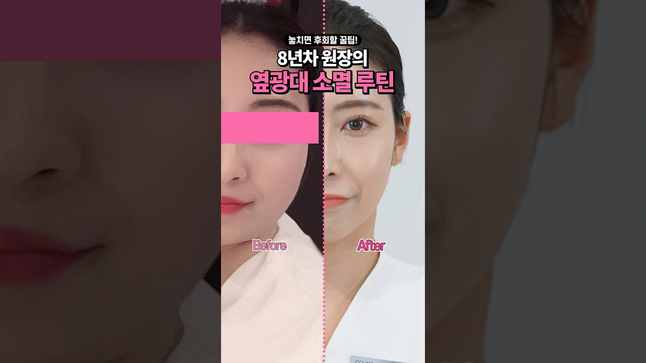 ✨8년차 원장의 옆광대 소멸 루틴✨