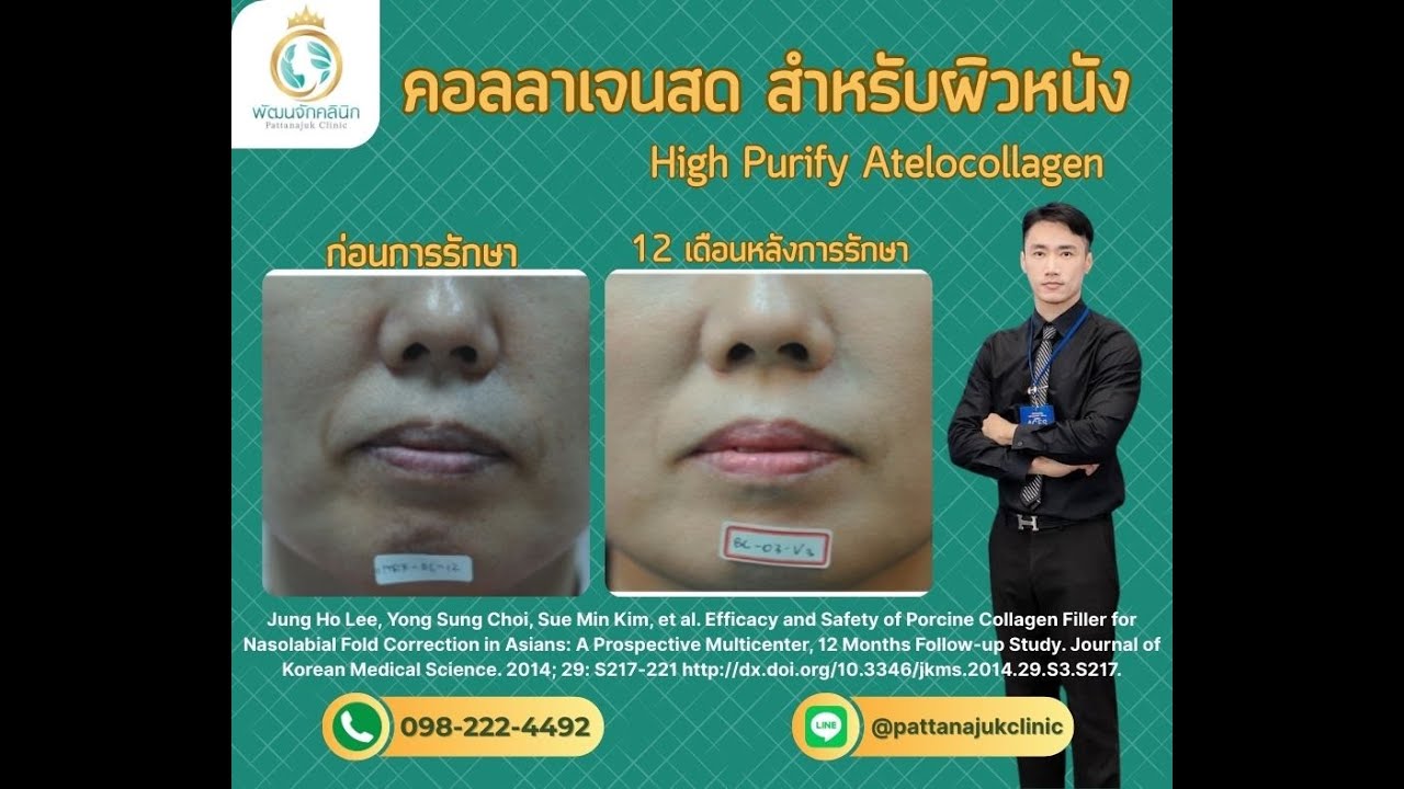 คอลลาเจนสดสำหรับผิวหนัง