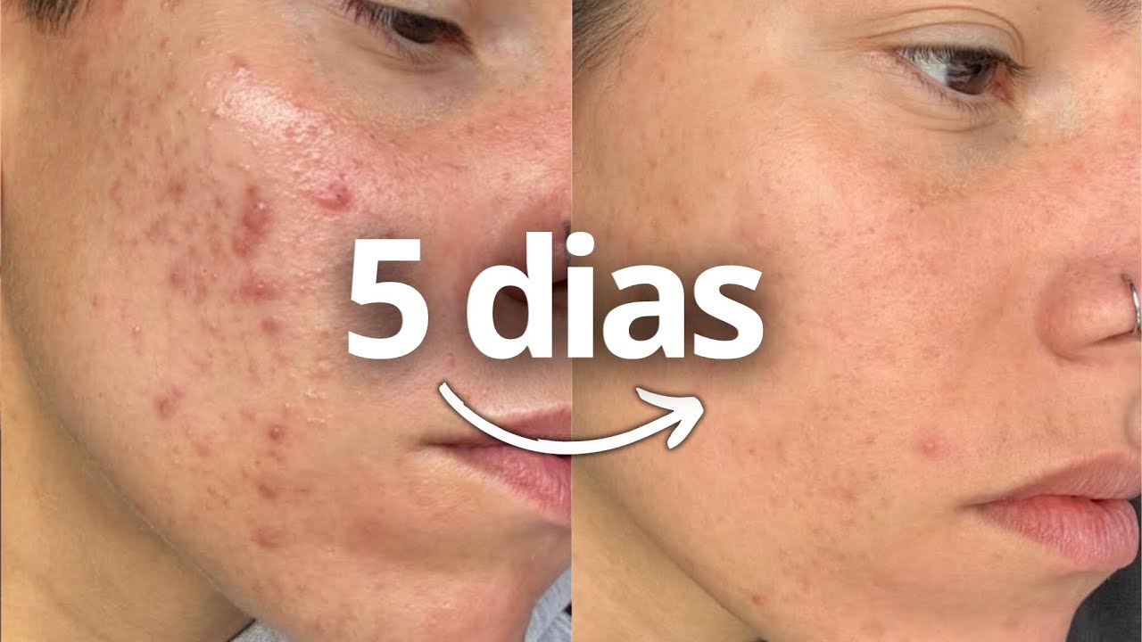Pele feia? Tenta essa rotina realista por 5 DIAS e se surpreenda
