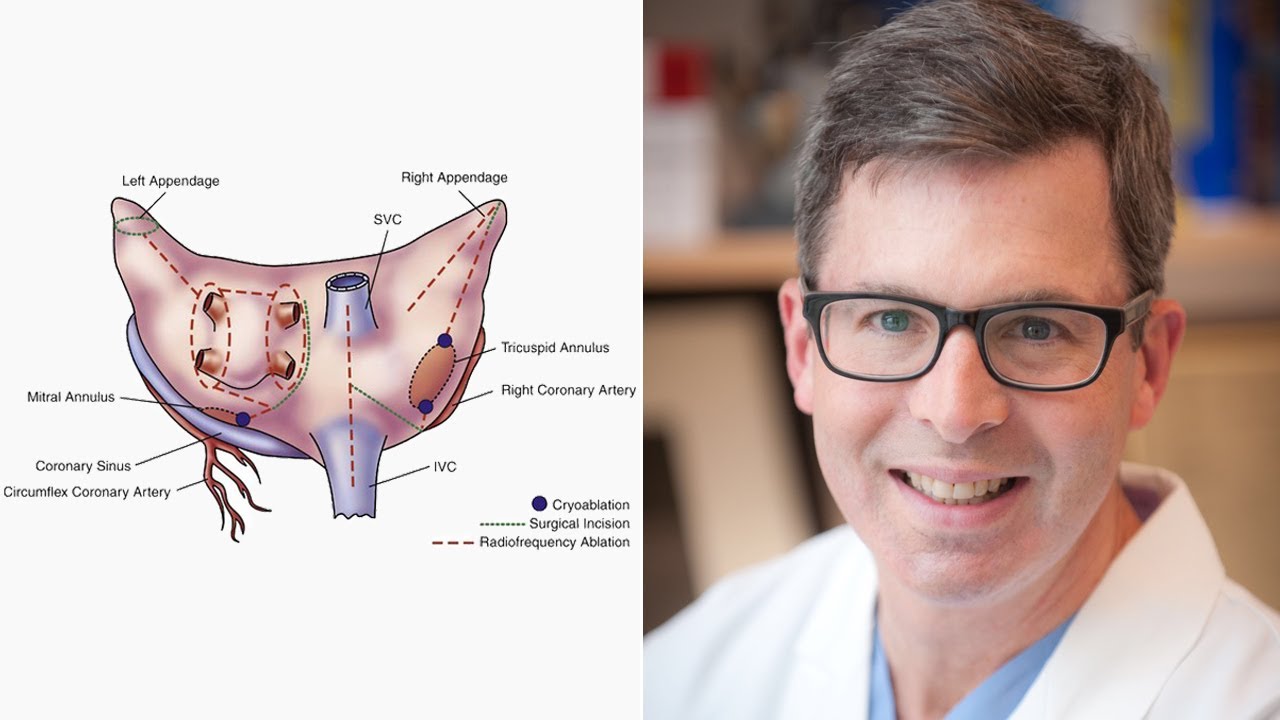 Surgeon Q&A: Cox-Maze IV Insights & AFib Pathology to Help Your Practice (with Dr. Marc Gillinov)