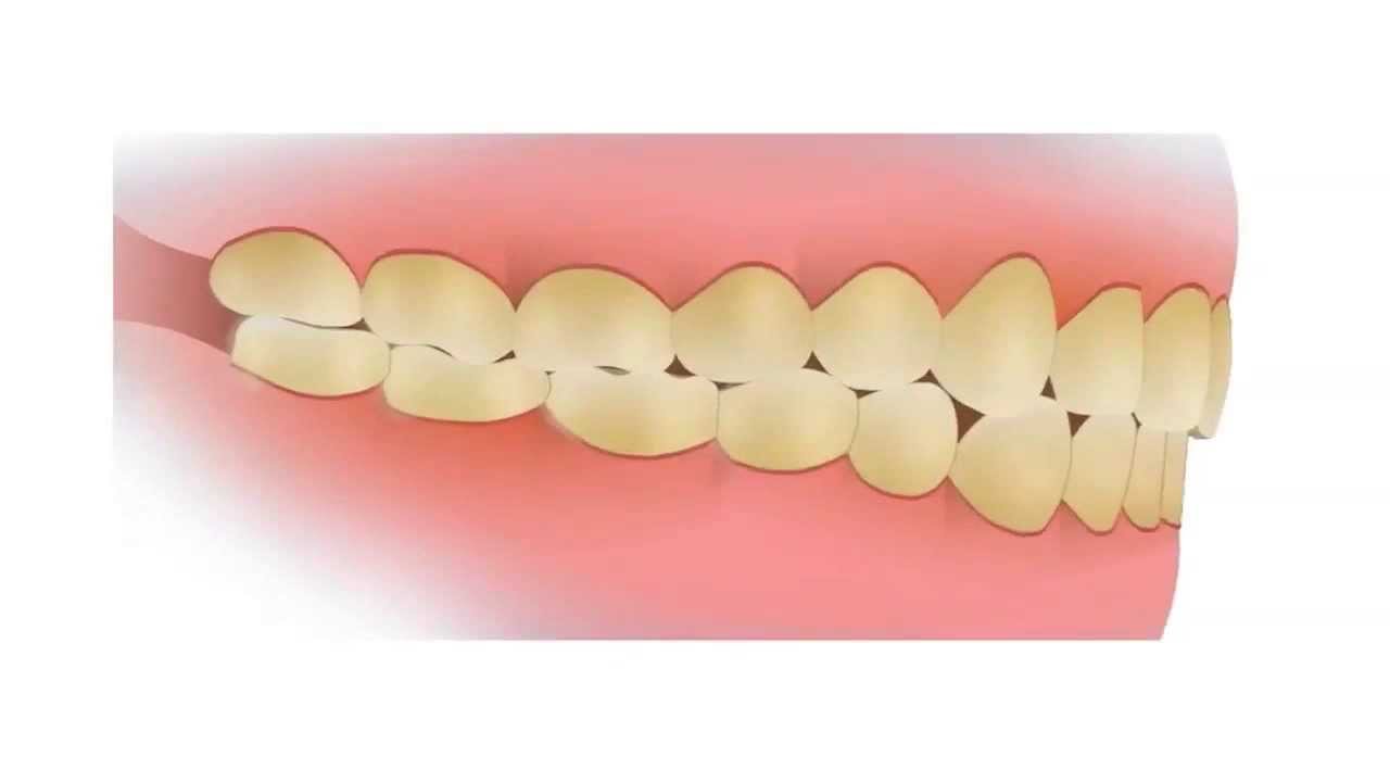 Common Dental Problems: Plaque