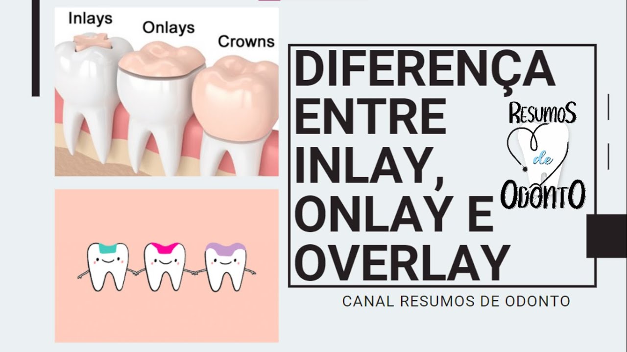 Explicando sobre inlay, onlay e overlay | Resumos de Odonto