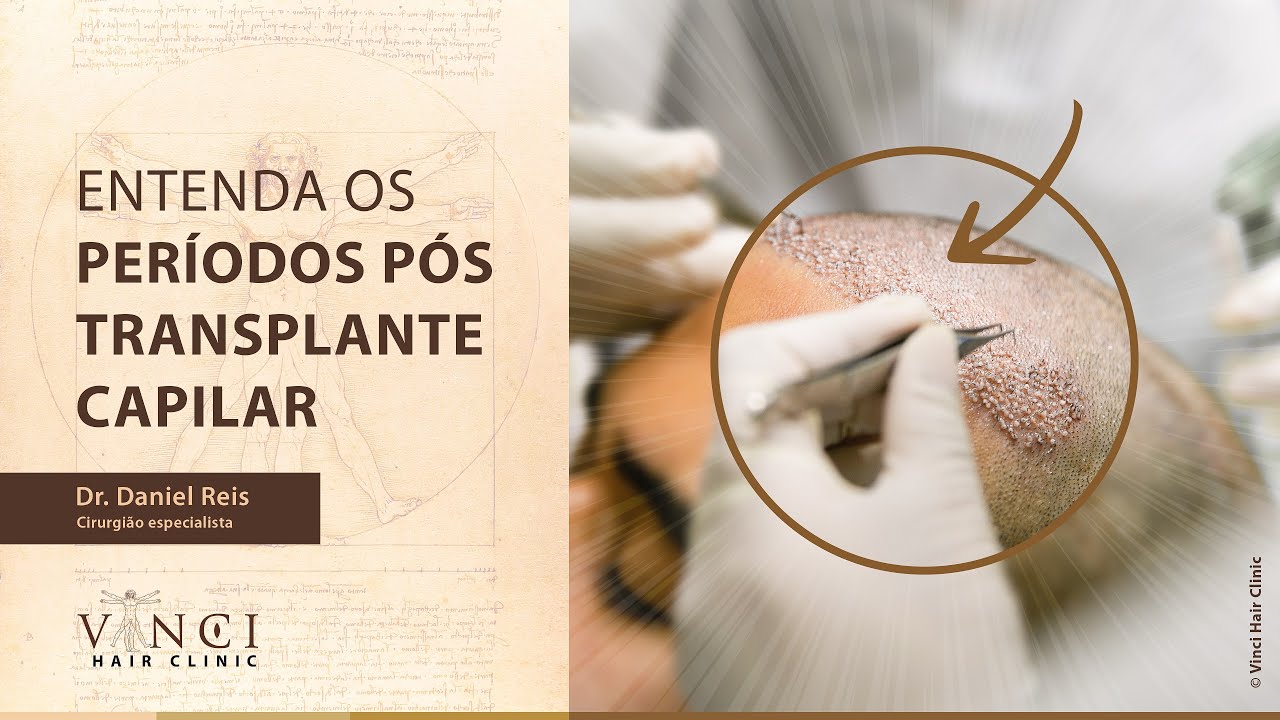 ETAPAS PÓS TRANSPLANTE CAPILAR - SAIBA TUDO!