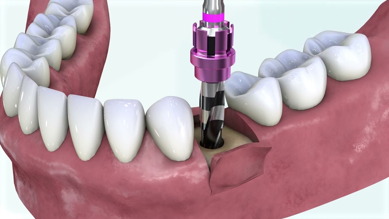Kontact Surgery Animation