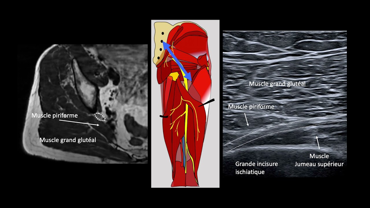 ECHOGRAPHIE DES NERFS DU MEMBRE INFÉRIEUR : B. BORDET - LE NERF SCIATIQUE