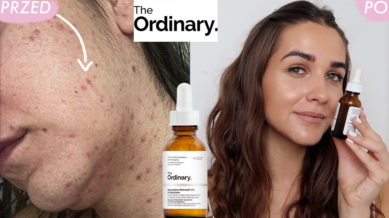 JAK POZBYŁAM SIE TRĄDZIKU | RETINOL z THE ORDINARY oczyścił moją sk&oacute;rę w 3 miesiące
