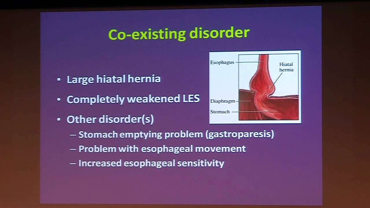 Can You Have Reflux Without Heartburn? | Dr. Kevin Ghassemi
