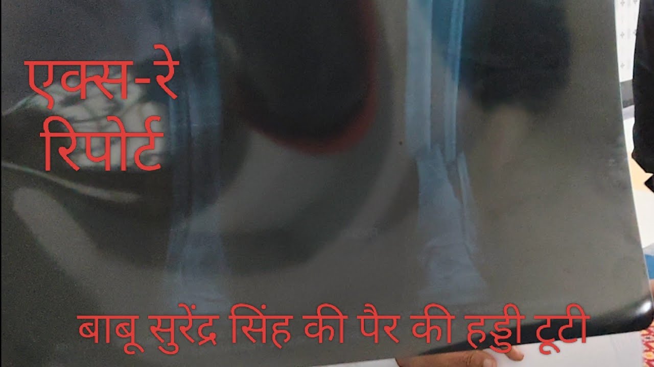 नौटंकी के हीरो बाबू सुरेंद्र सिंह से मिलने पहुंचे त्रिभुवन हीरो सरदार हॉस्पिटल सोरांव 