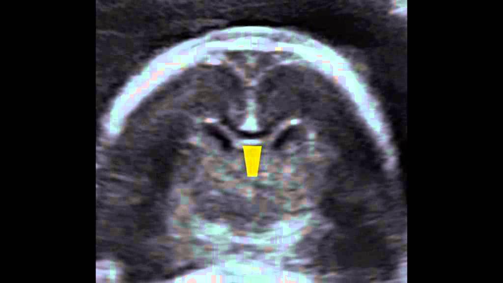 ISUOG: How to image the fetal corpus callosum: the coronal to median plane approach