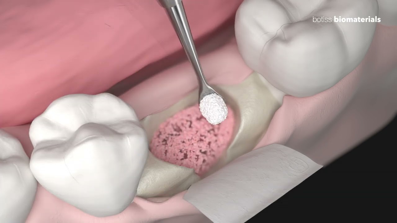 Ridge preservation with cerabone® and Jason® membrane
