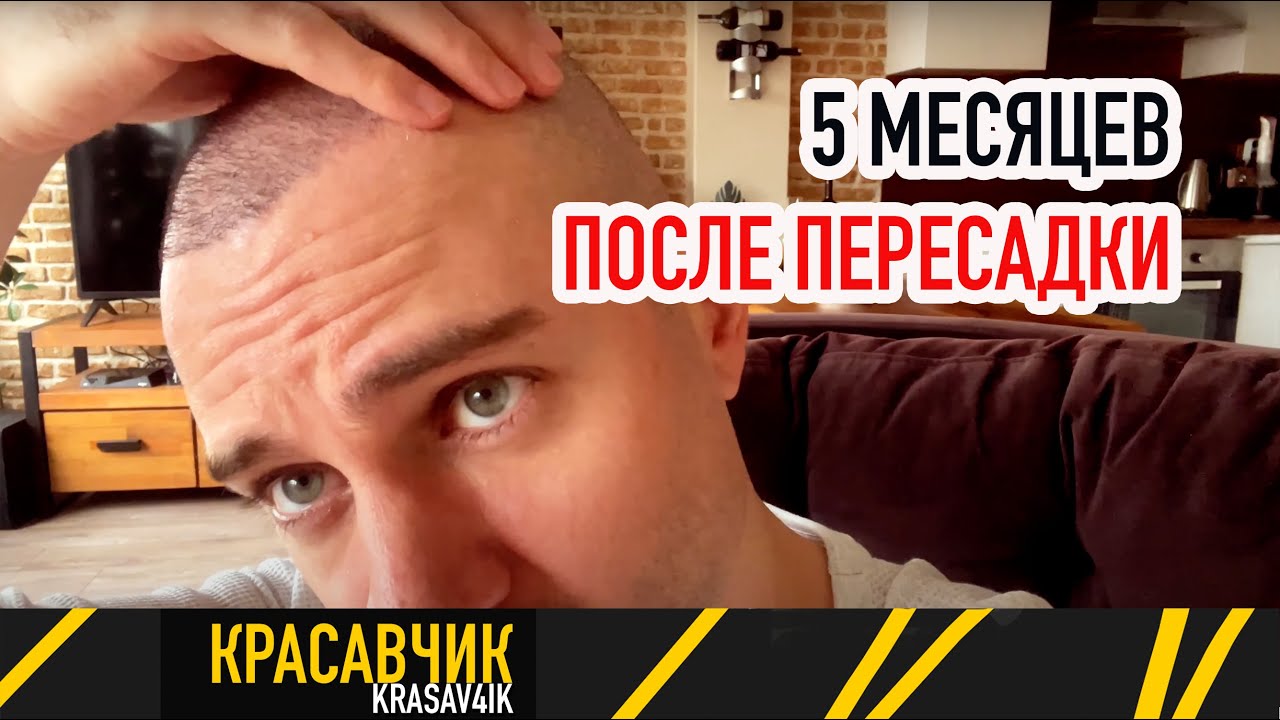 5 месяцев после пересадки волос \ Красавчик