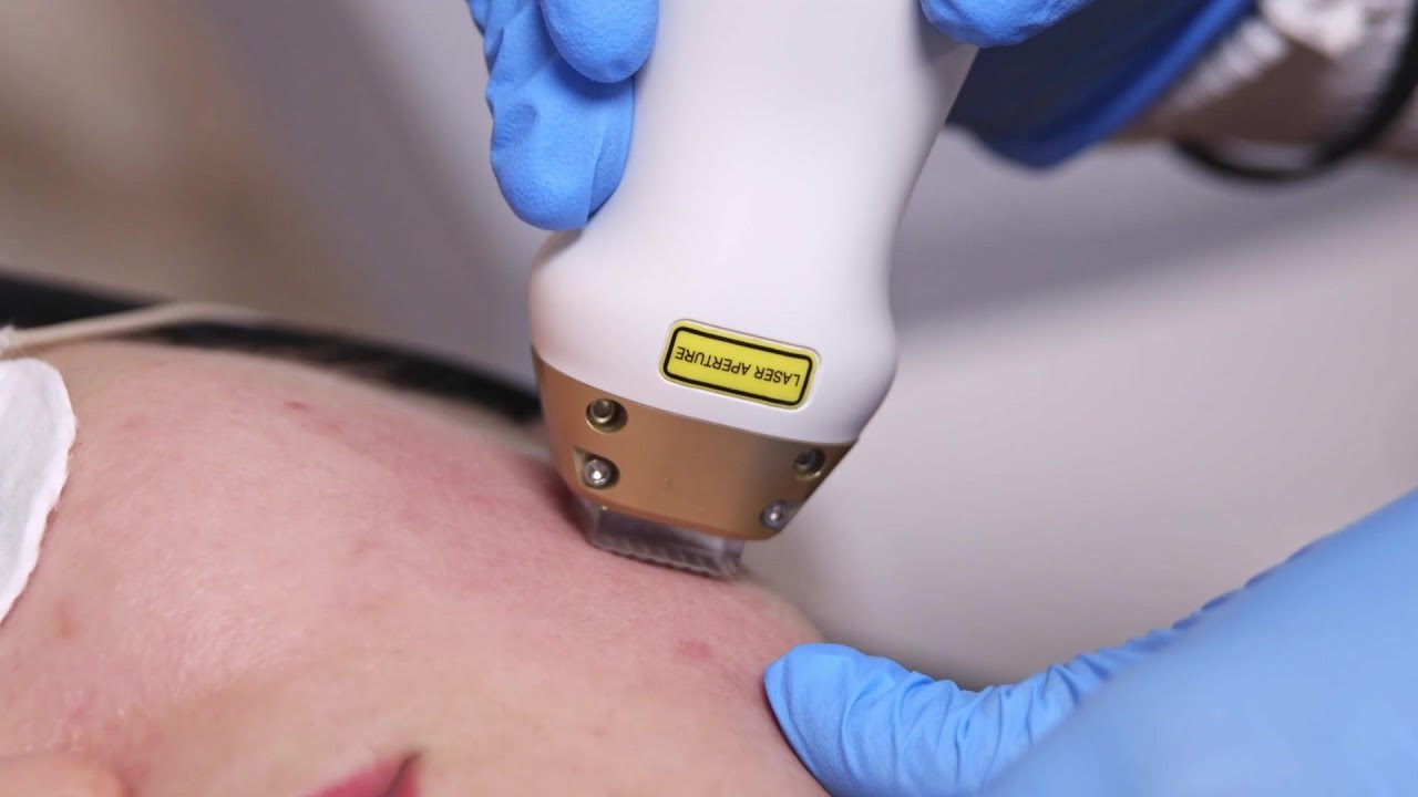 Terapia blizn potrądzikowych, głębokich zmarszczek, przebarwień i rozstęp&oacute;w w Beauty Lab Clinic