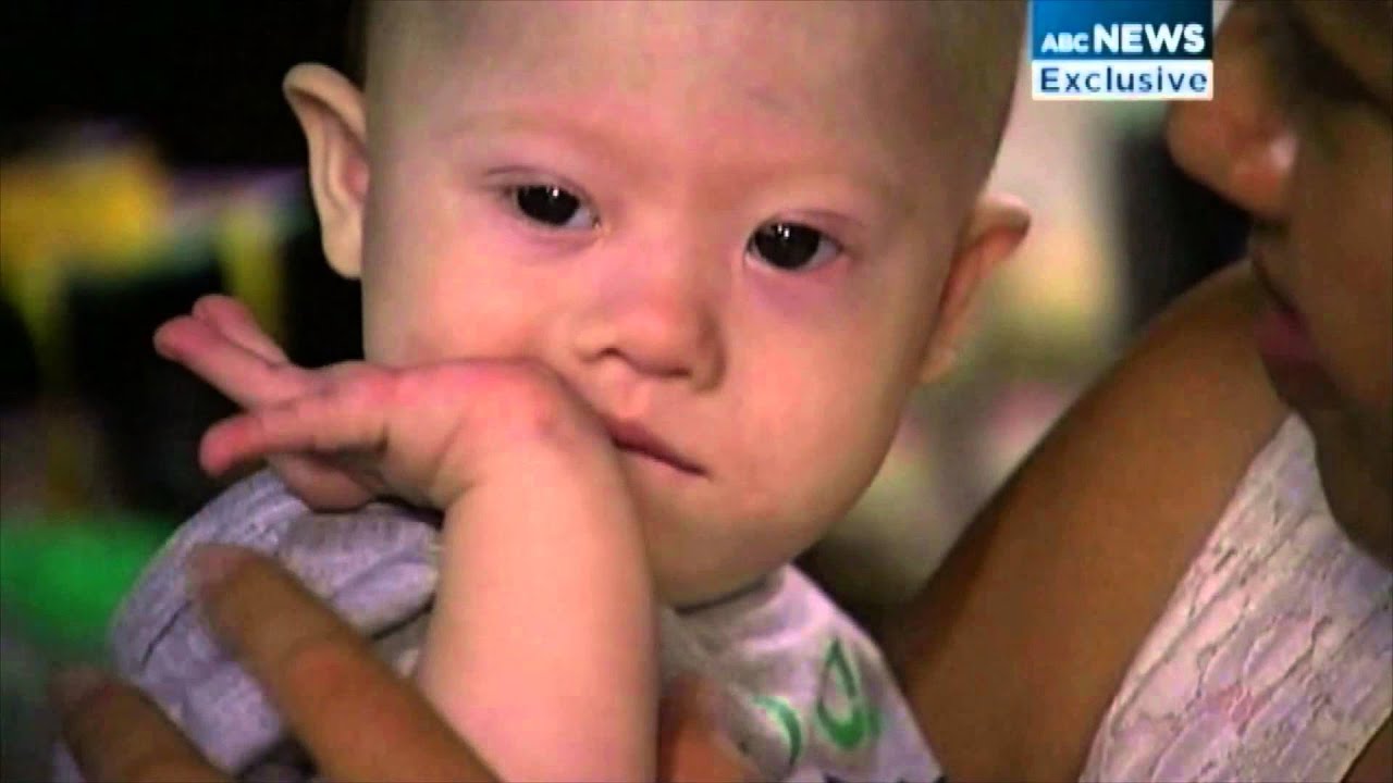 Un bébé trisomique né de mère porteuse abandonné par ses parents