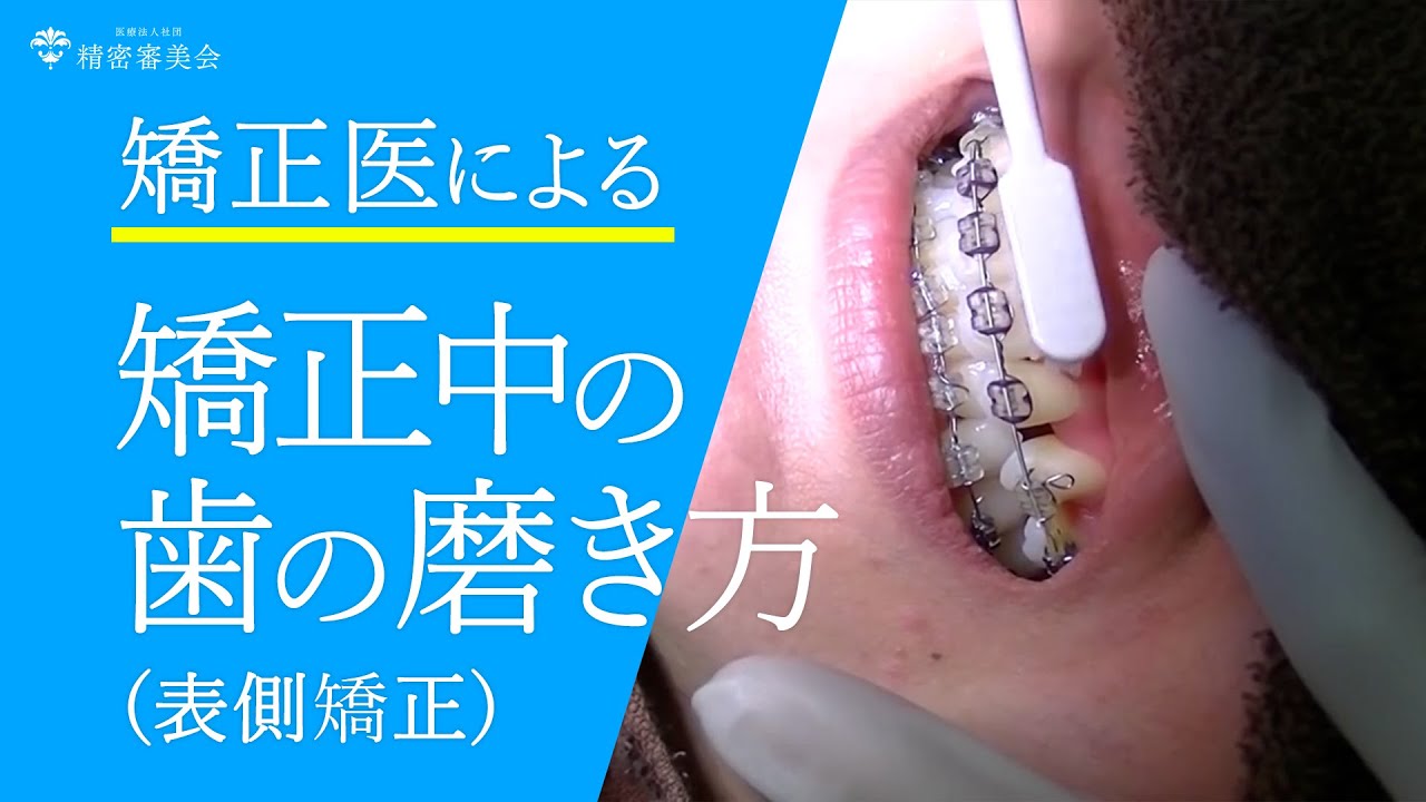 歯の矯正中の歯磨きの仕方（表側装置編） [矯正医による説明]