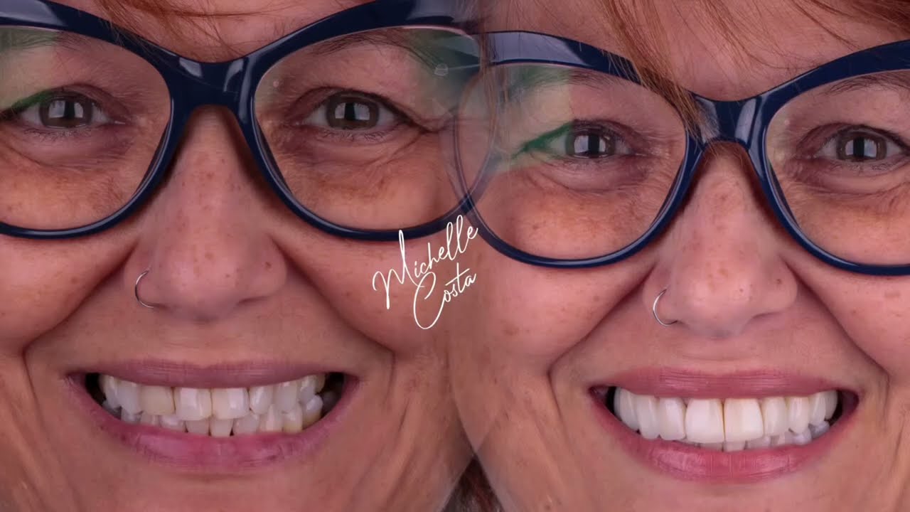 Transformações Incríveis: Antes e Depois de Lentes em Resina!