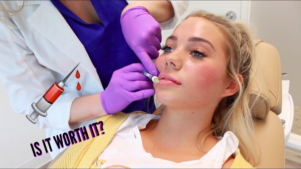 I GOT MY LIPS DONE! IS IT WORTH IT? VLOG!