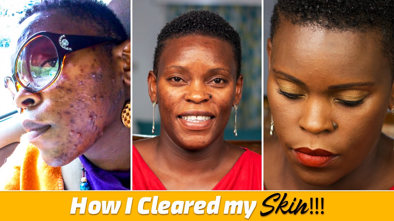How I Got Rid Of Acne