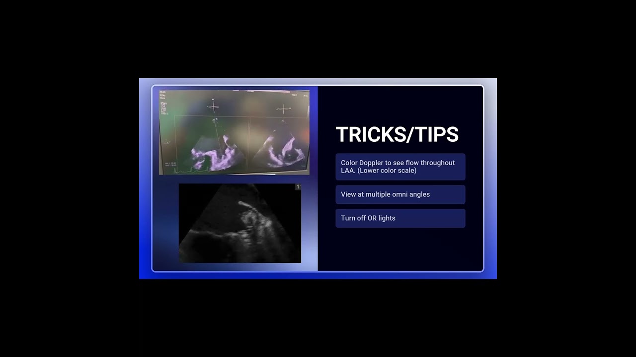 How to Optimize Left Atrial Appendage Imaging on TEE: Practical Tips