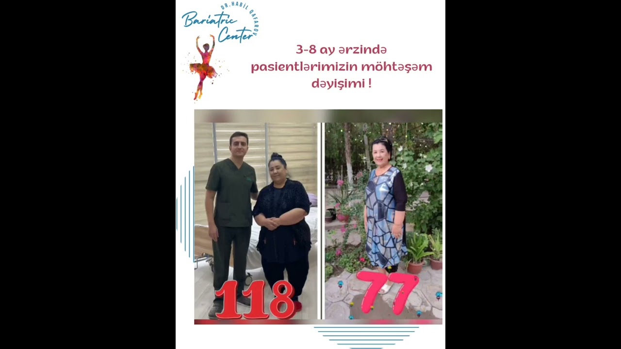 Happy 🎊Moments 😍 После операции по уменьшению желудка! Bariatric cərrah - Dr.Habil Qafarov