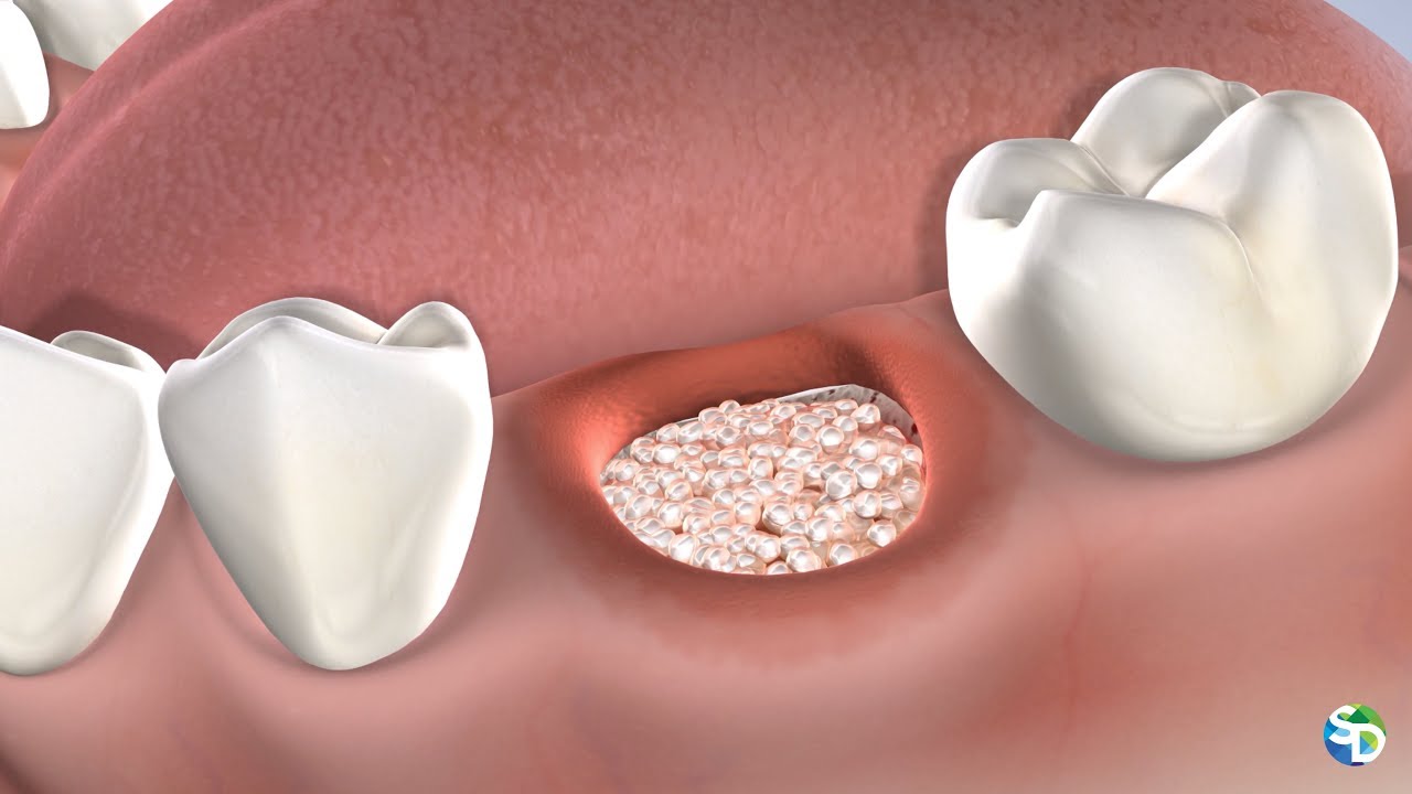 Socket Preservation After Tooth Extraction | San Diego, CA