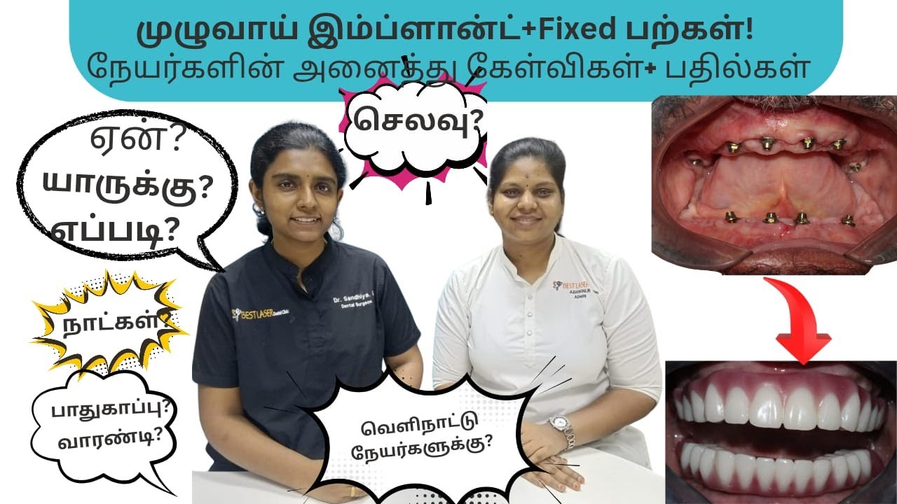 முழுவாய் இம்பிளான்ட் + fixed பற்கள்  அனைத்து தகவல்கள்! All about full teeth dental implants
