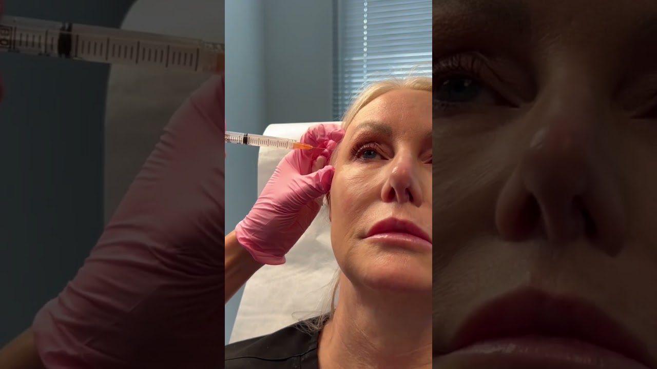 Sculptra Injections & Neck Rejuvenation | Dallas Dermatology Partners | Dr. DicksonFebruary 26, 2024