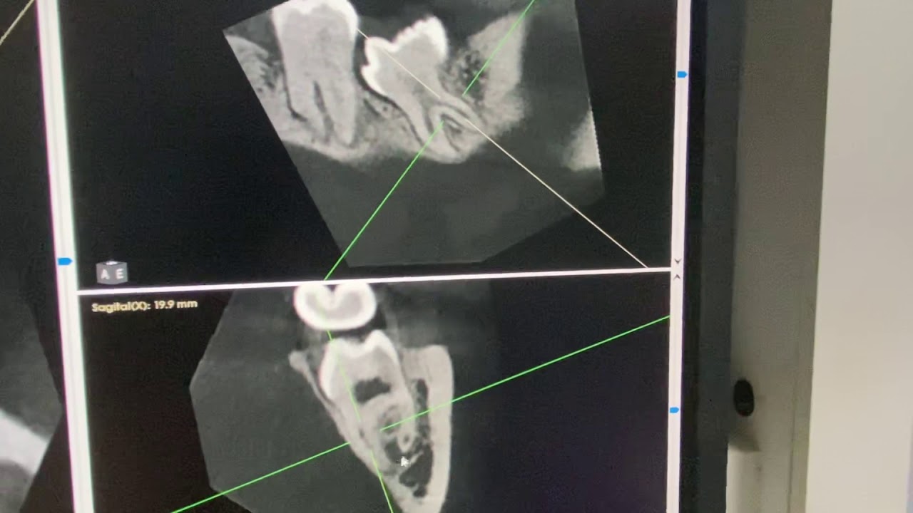 Auxílio da tomografia computadorizada cone beam nas cirurgias de terceiros molares