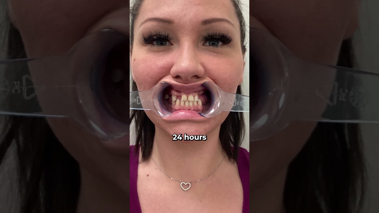 After years of drug abuse devastated her teeth 🦷 She was able to get her SMILE BACK 🤩
