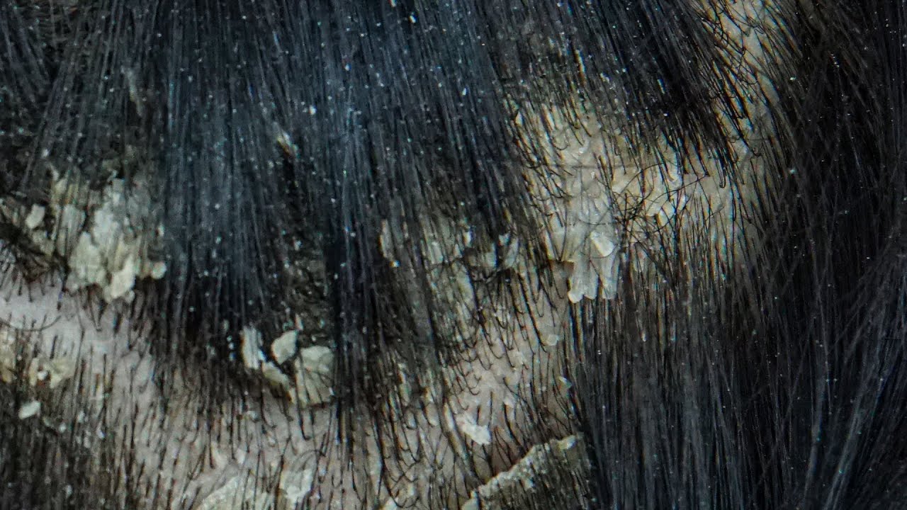 ASMR Satisfying Dandruff Treatment & Scalp Check #0002