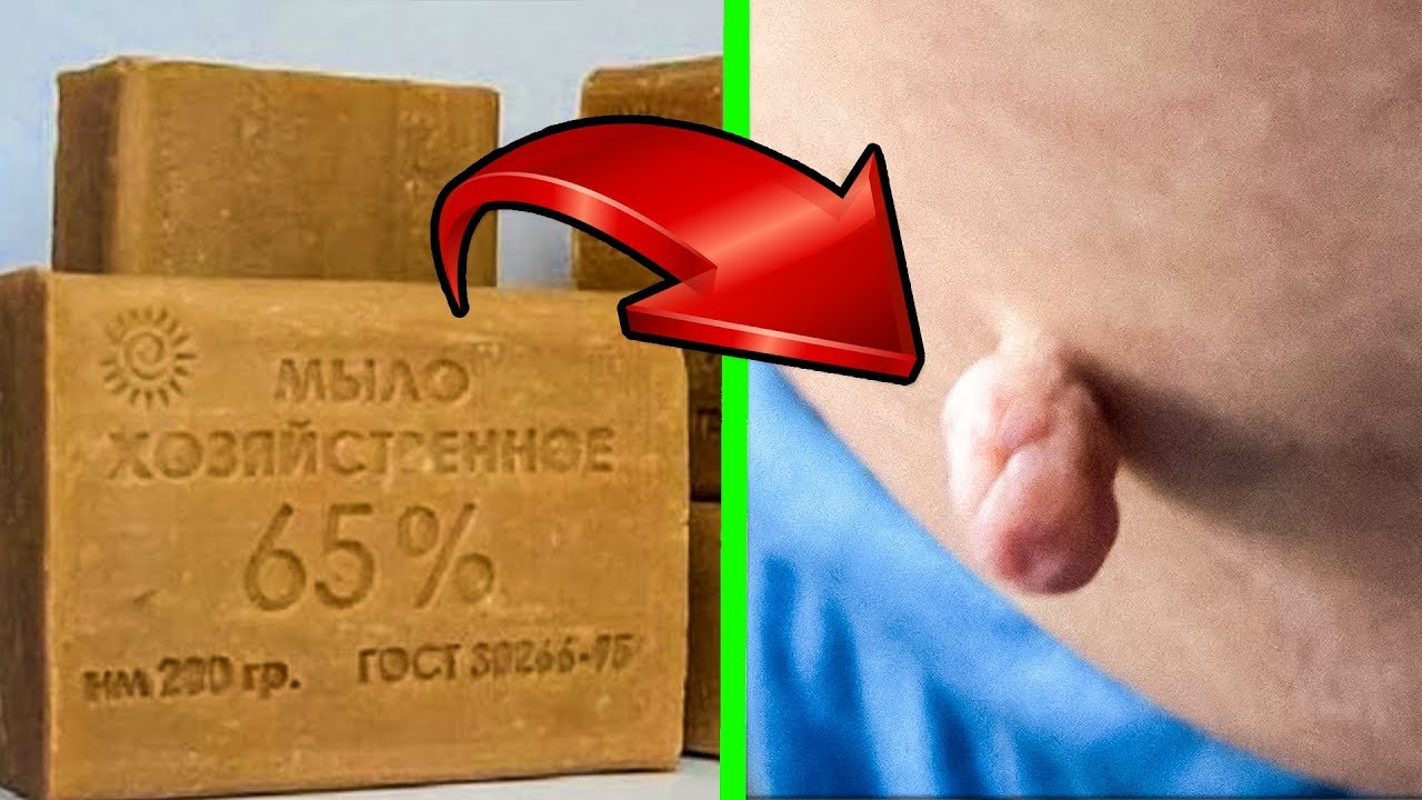 Неожиданное применение Хозяйственного мыла для удаления Папиллом. Нужно...