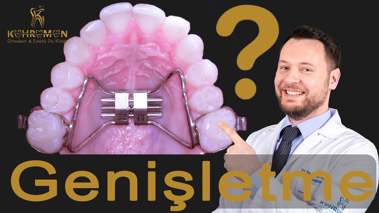 Hızlı Üst Çene Genişletmesi