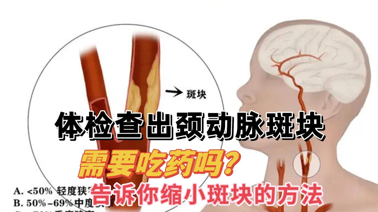 体检查出颈动脉斑块，都需要吃药吗？告诉你让斑块稳定的方法
