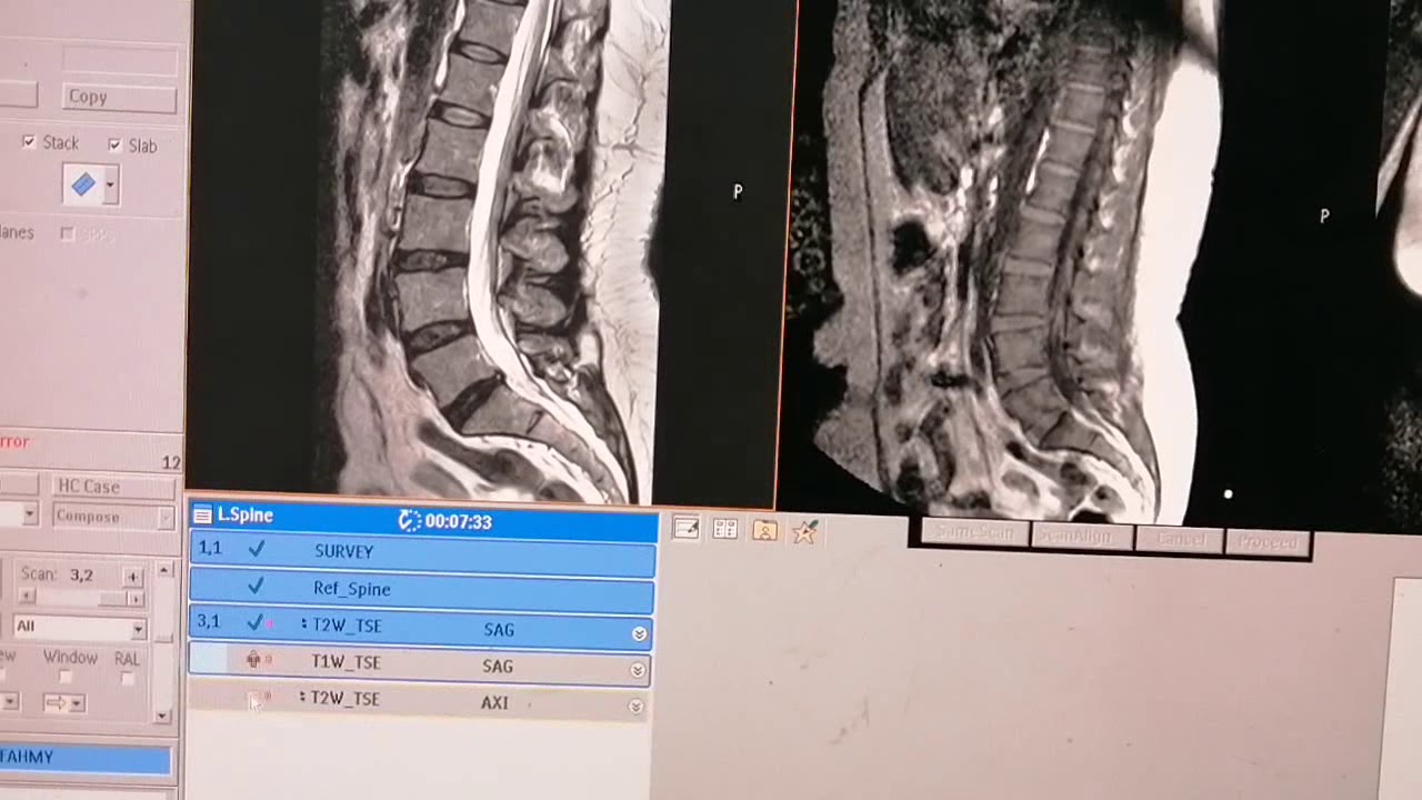 كيفيه عمل رنين مغناطيسي على الفقرات القطنيه على جهازHD Philips
