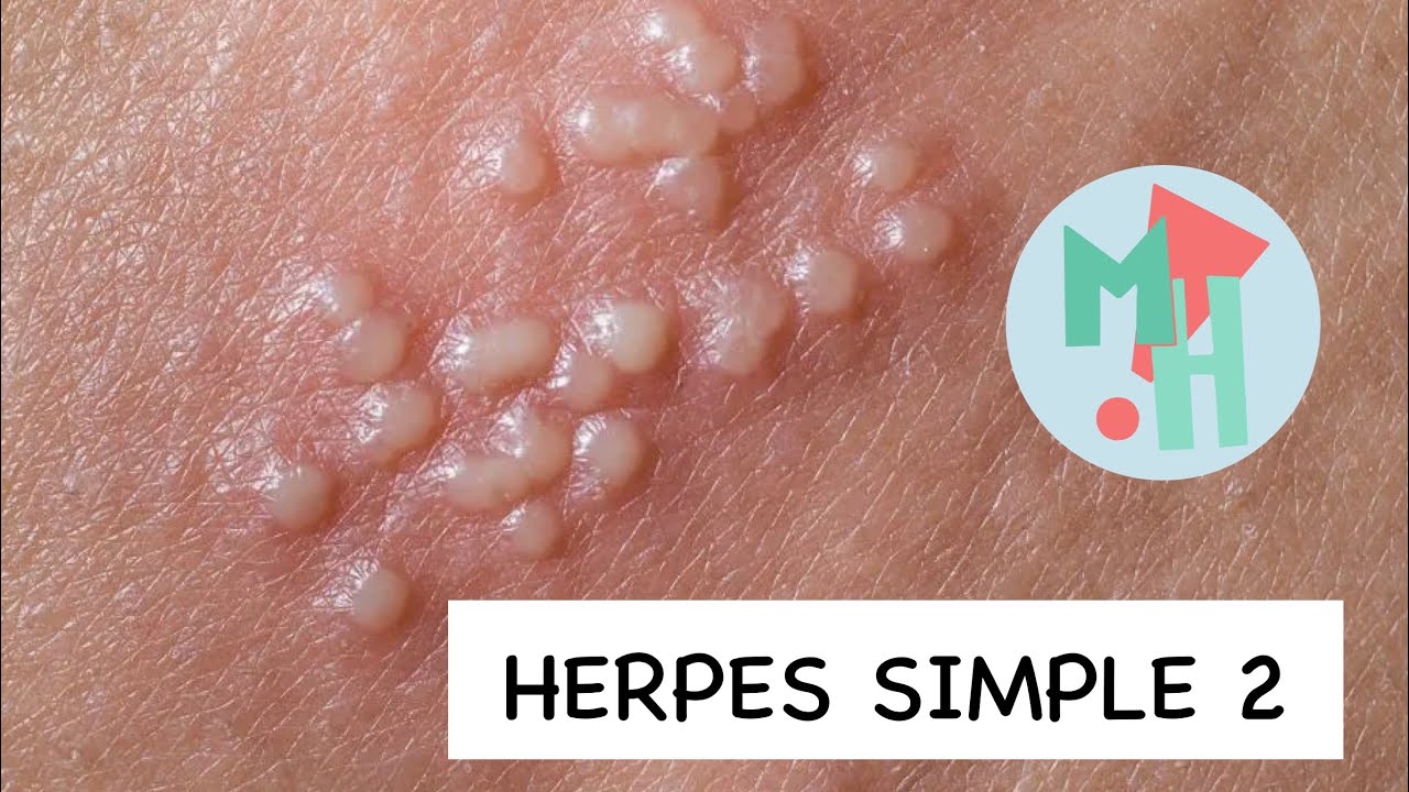 Todo sobre el VIRUS DE HERPES SIMPLE 2