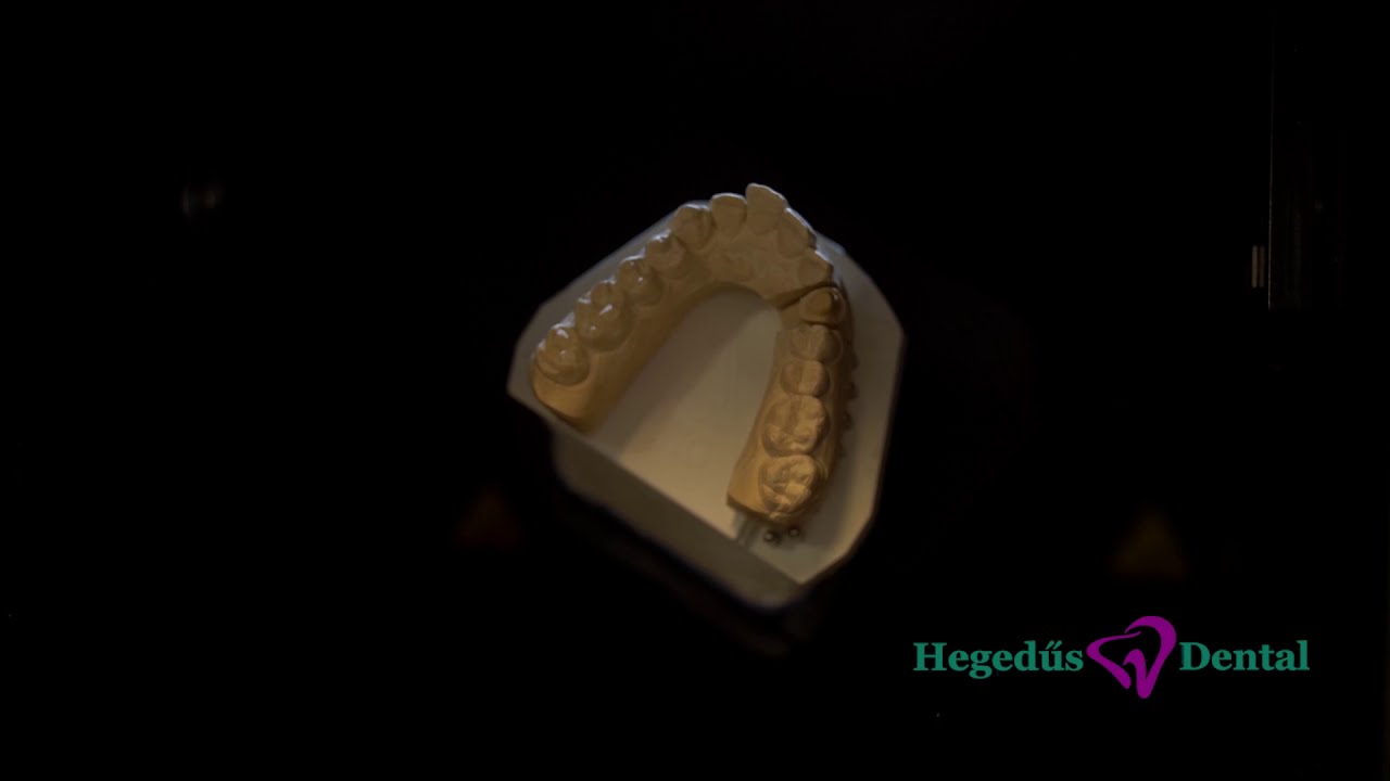 Hegedűs Dental - Cirkon korona CAD/CAM