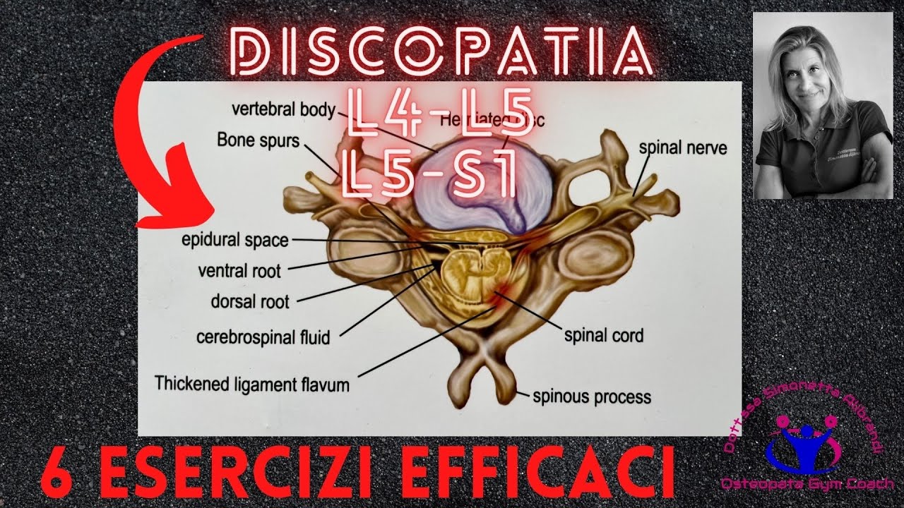 DISCOPATIA LOMBARE L4-L5/L5-S1 : 6 ESERCIZI EFFICACI