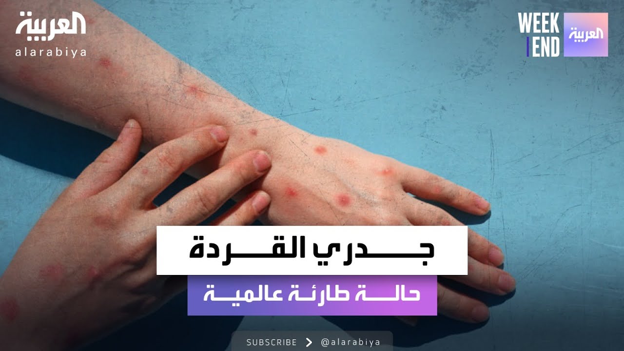 الصحة العالمية تعلن حالة طوارىء عالمية بسبب فيروس جدري القردة