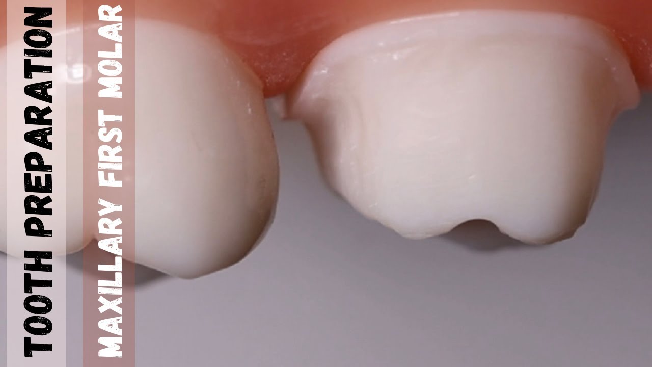 Maxillary First Molar 🔵 Tooth Preparation for PFM 🟡 Step by Step Demonstration