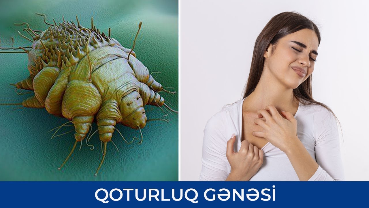 Qoturluq gənəsi - Qoturluq xəstəliyi - Fərid Məsməliyev ( Mikrobioloq / Virusoloq )