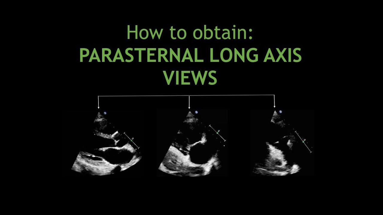 How to obtain: PARASTERNAL LONG AXIS VIEWS!