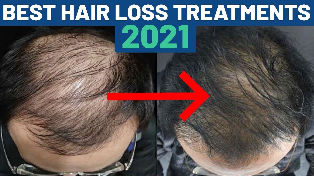 Best Hair Loss Treatments Ranked 1-10 in Order of Effectiveness