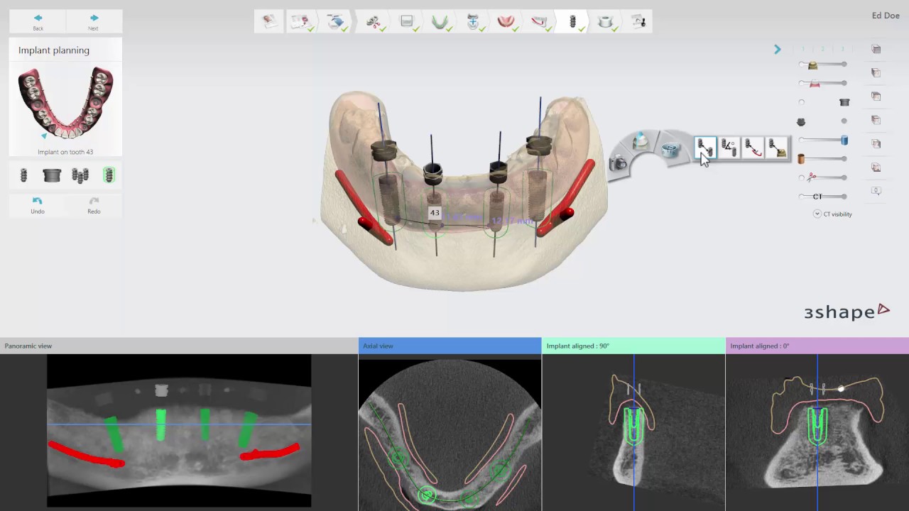 3Shape Implant Studio - Edentulous Case - 4.How to Perform Implant Planning