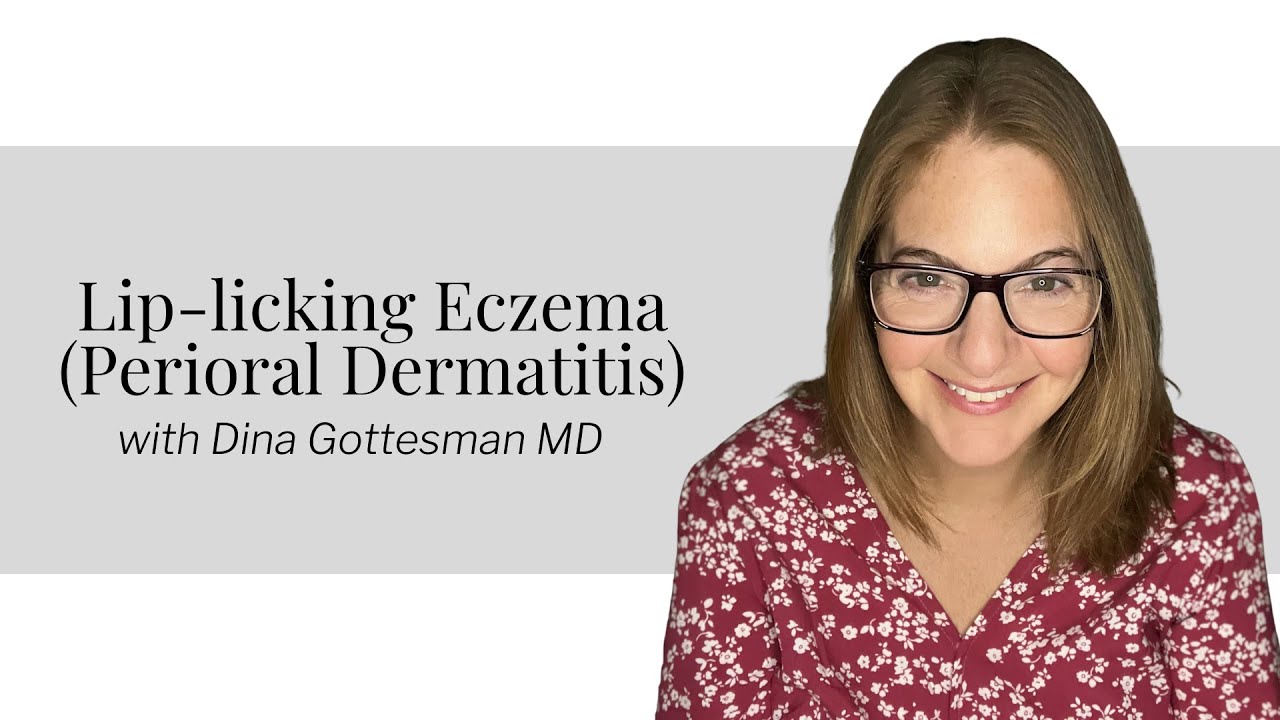 Lip Licking Eczema (Perioral Dermatitis)