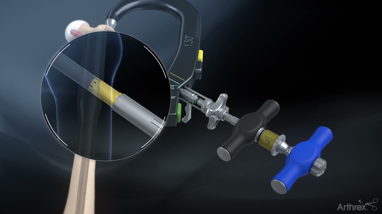 Trochanteric Nail System With Telescoping Lag Screw