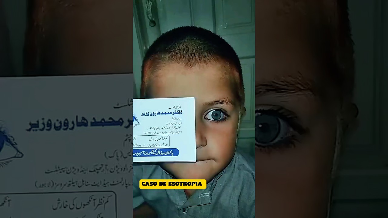 ESOTROPIA en ni&ntilde;os #medicine