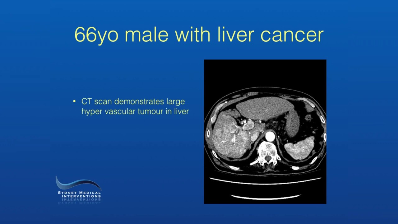 Liver Tumour Embolisation