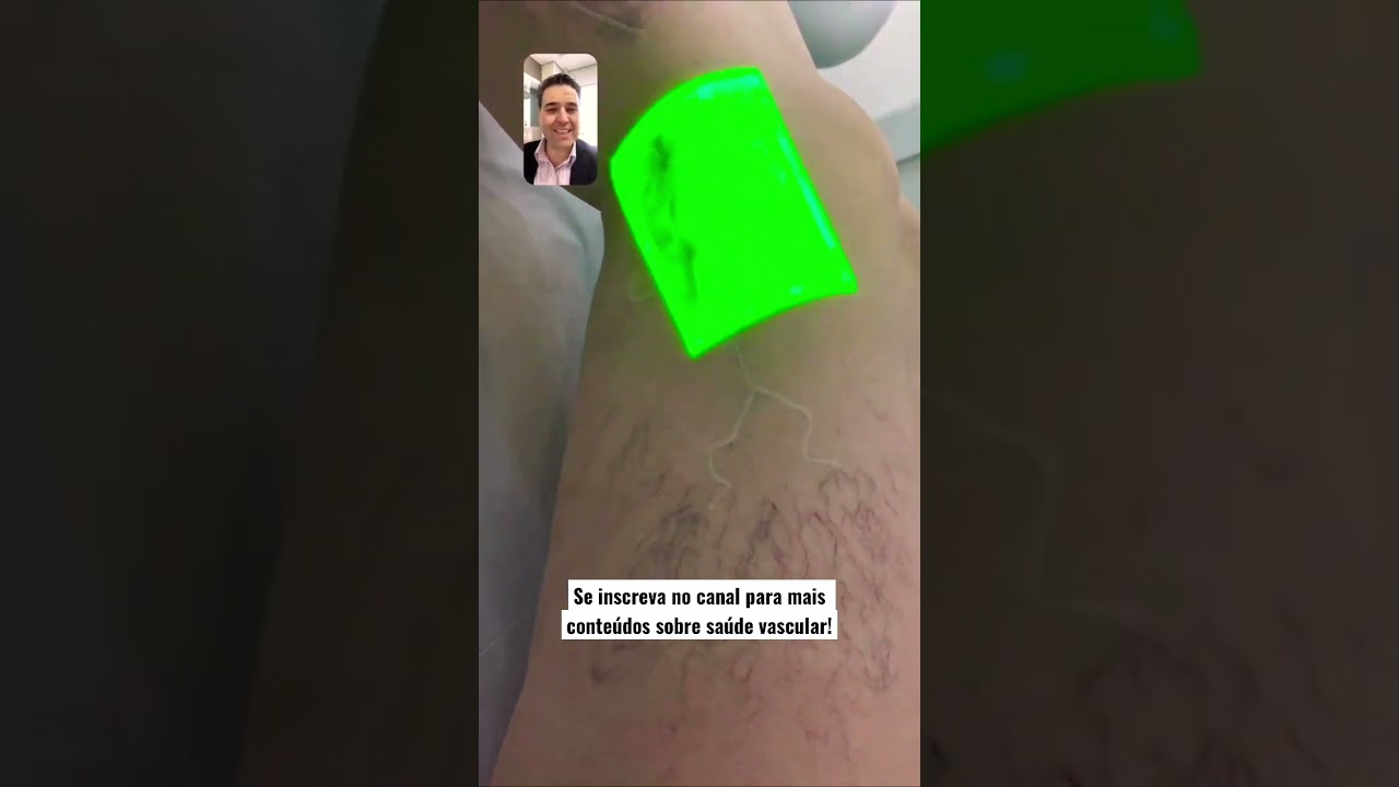 Quanto custa uma sess&atilde;o para tratamento das #varizes ?